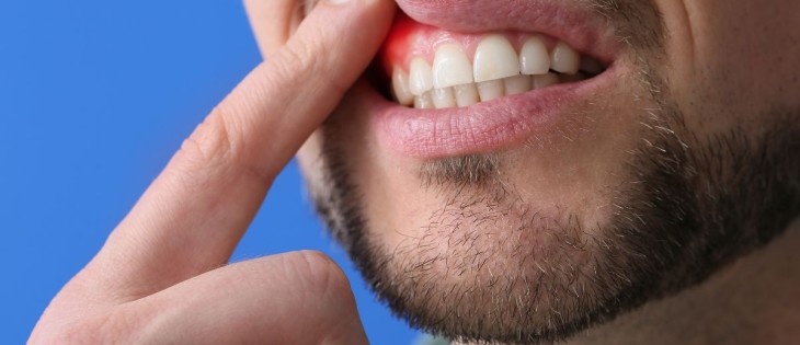Prevenir la gingivitis: una inversión en tu salud bucal a largo plazo
